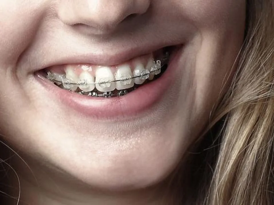 Close-up of a smile with tooth-coloured ceramic brackets – ceramic braces in Dombivli
